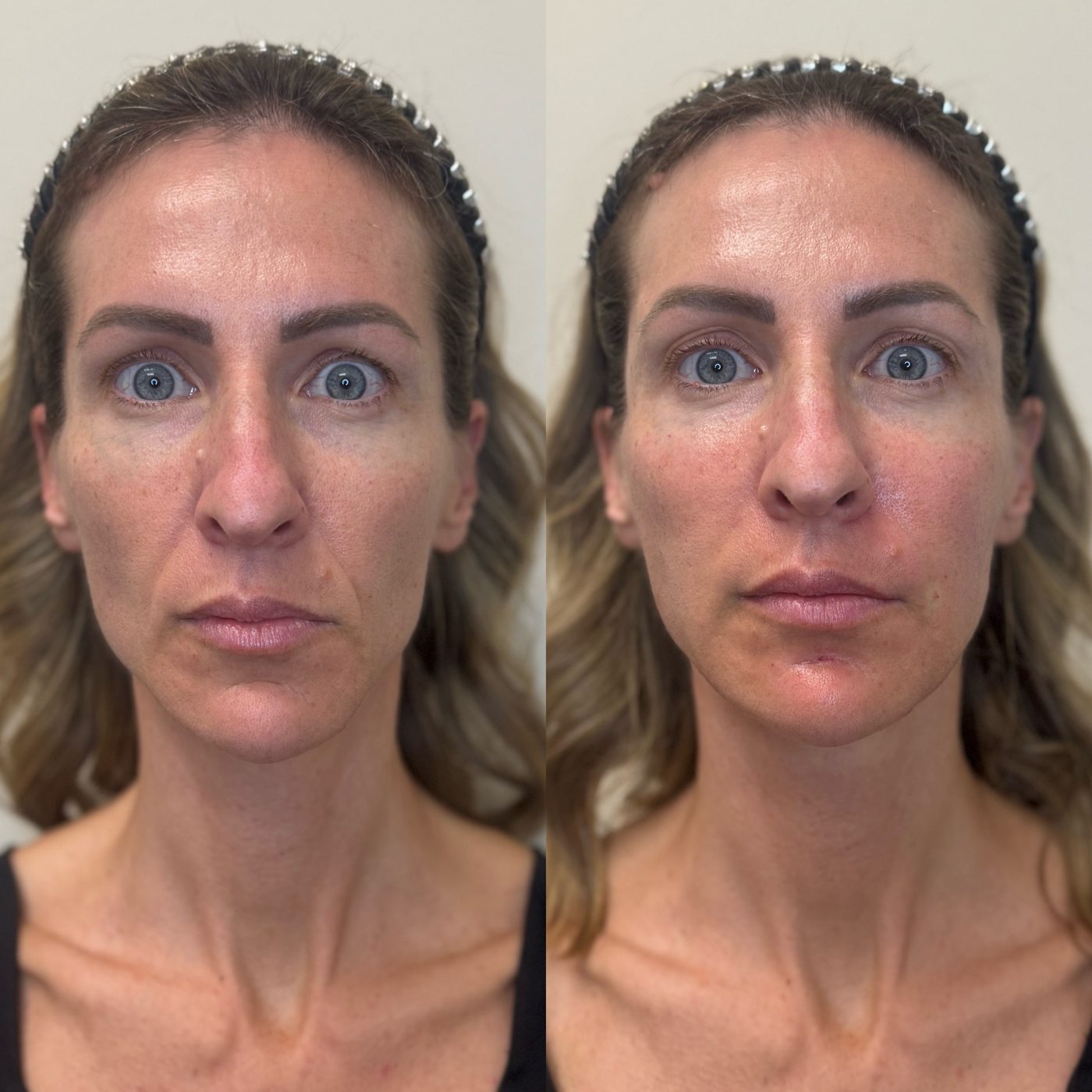 Front view of a female patient before and immediately after dermal filler and Sculptra, showing restored volume through the cheeks, lips and lower face following GLP-1 weight loss