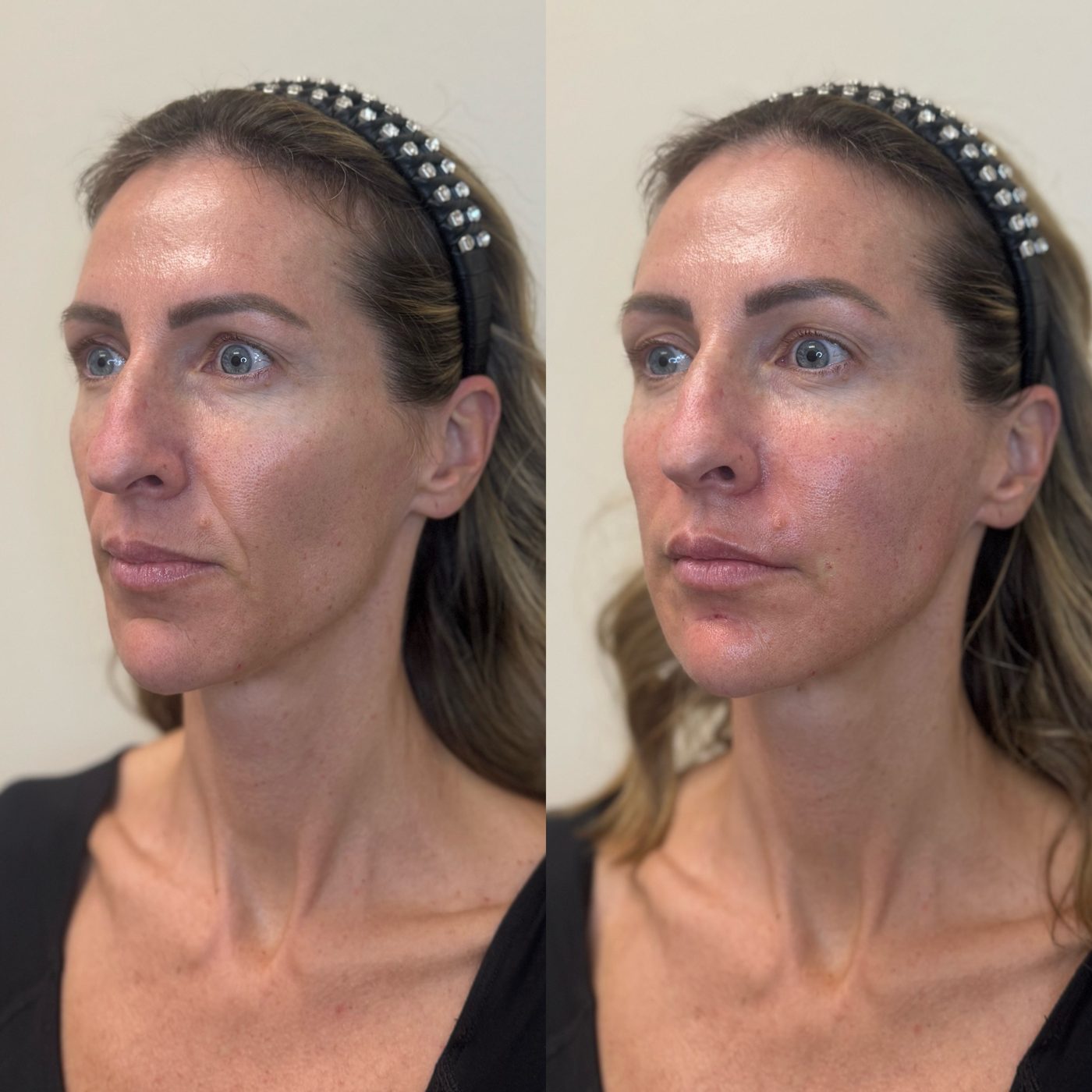 Three-quarter view of a female patient before and immediately after dermal filler and Sculptra to restore facial volume lost during GLP-1 weight loss