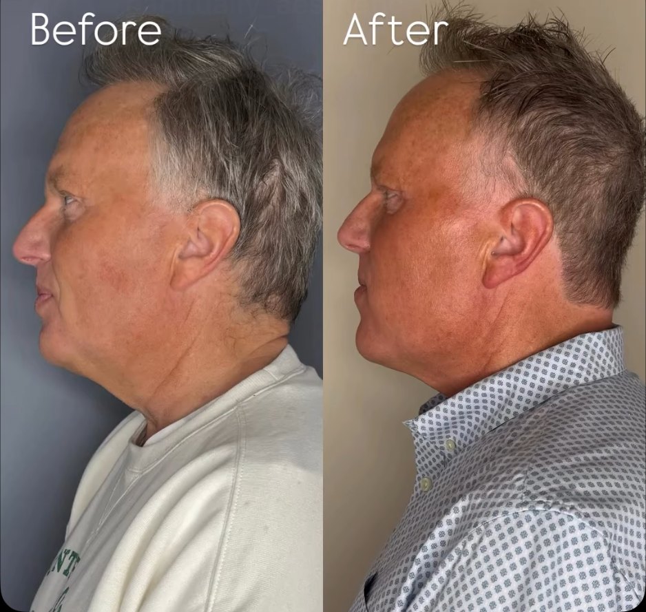 Side profile of a male patient before and after chin and jawline filler, showing improved chin projection and a more defined jaw contour