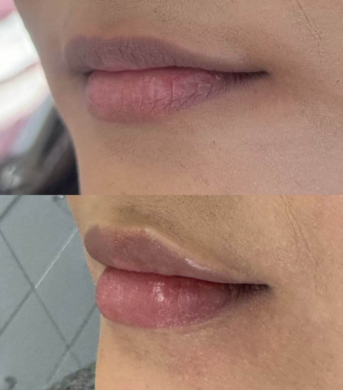Close side view of a patient’s lips before and after filler, showing corrected asymmetry and a more even vermilion border