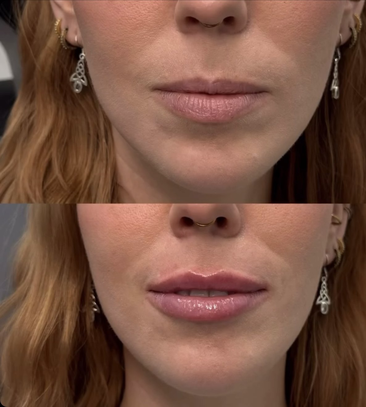 Front view of a patient’s lower face before and immediately after lip filler, showing improved upper-to-lower lip balance with post-treatment swelling present