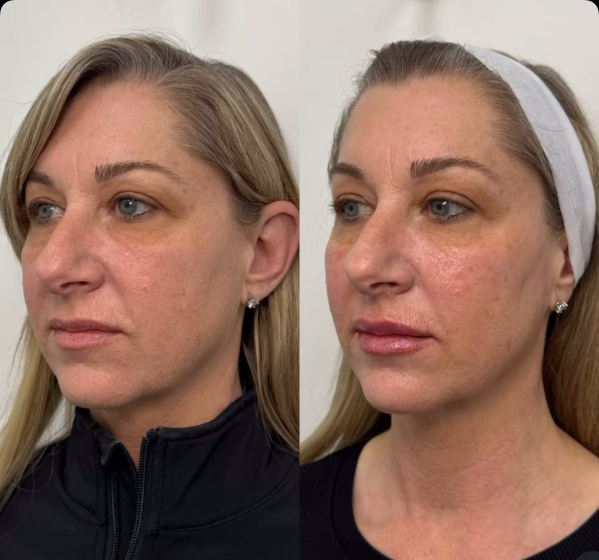 Three-quarter view of a female patient before and after midface filler, showing softened under-eye hollowing and restored cheek support