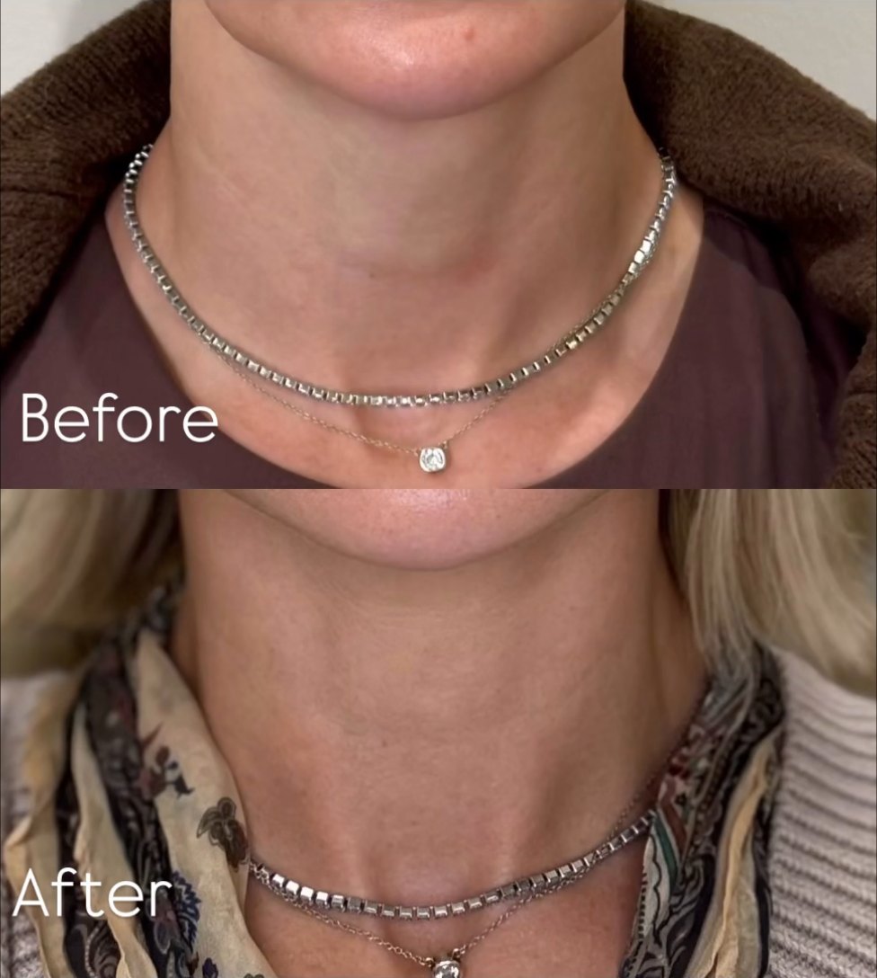 Front view of a patient’s neck before and after one session of hyperdilute Radiesse, showing smoother skin texture and softened horizontal neck lines