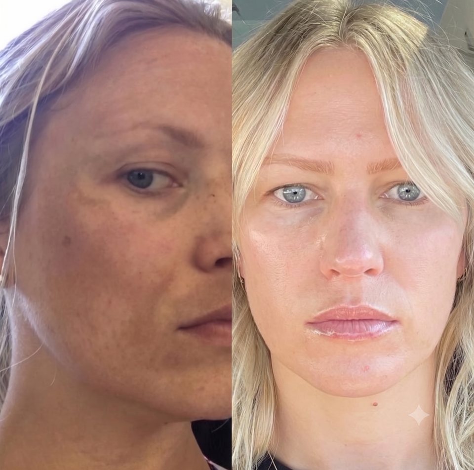 Split image of Lindsey Strelecki’s own face, before and after a course of medical-grade skin treatments and upper-face Botox, showing more even skin tone on the treated side